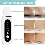 STELLAR - 5-Function EMS Lifting Exfoliator - Ultrasound & Photon Treatment