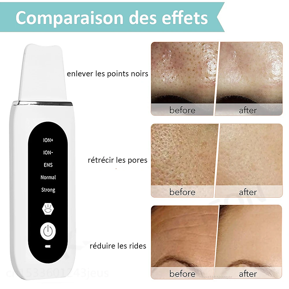 STELLAR - 5-Function EMS Lifting Exfoliator - Ultrasound & Photon Treatment
